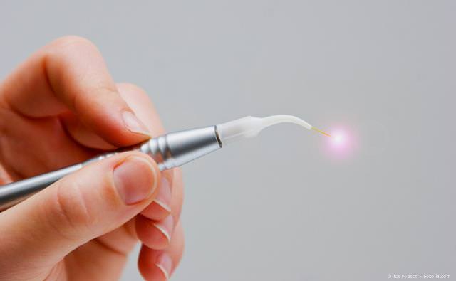 Dental-Laser für schmerzarme und blutungsfreie Behandlung