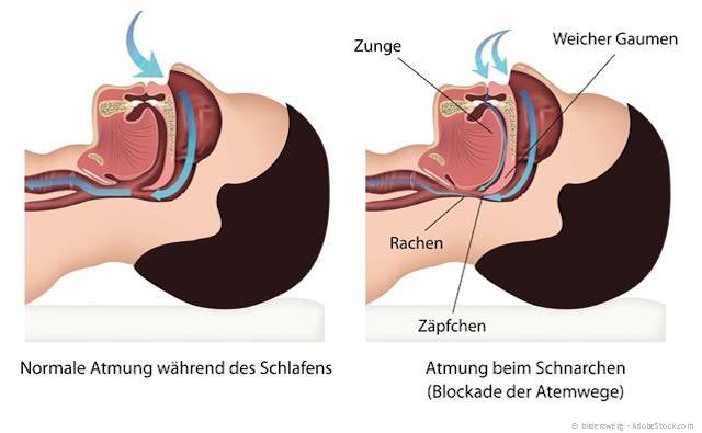 Die Ursache des Schnarchens: Blockierte Atemwege