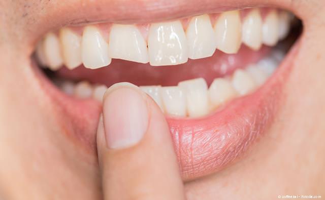 Abgebrochene Zahnecke: Wiederherstellung mit Veneer oder Komposit