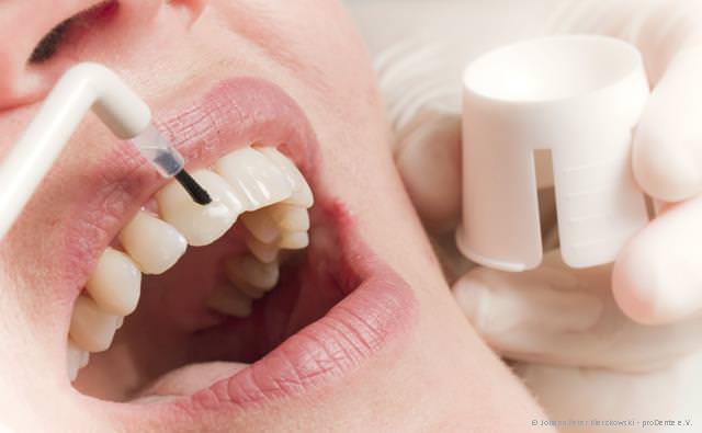 Um die Zähne während der kieferorthopädischen Behandlung zu schützen, werden sie mit einem Schutzlack versiegelt.