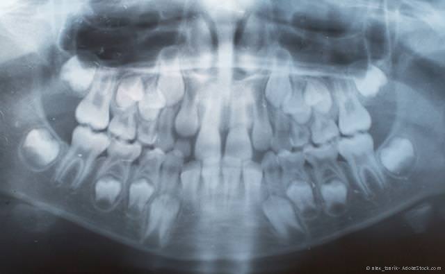 Röntgenaufnahme eines Wechselgebisses für die kieferorthopädische Behandlung