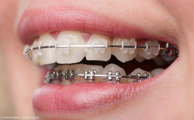 Feste Zahnspangen mit transparenten Brackets und aus Metall. Die Brackets werden über kleine Gummis oder dünne Drähte mit einem elastischen Draht verbunden, der über den gesamten Zahnbogen reicht.